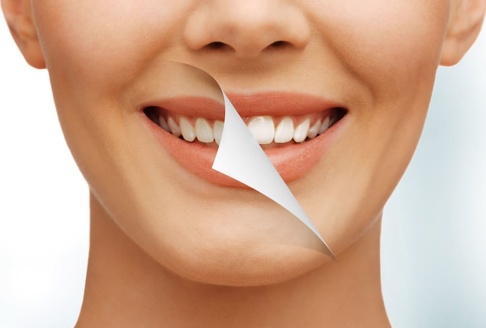Clareamento dental: conheça os tipos e escolha o seu!